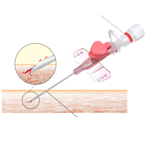I.V. Cannula