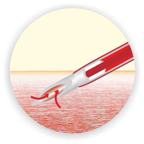 I.V. Cannula